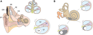 Cochlear Implants Linked to New Bone Formation, Increased Hearing Loss