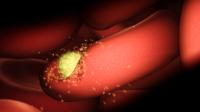 Malaria Parasite Infecting Red Blood Cell
