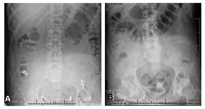 Magnetic Compression Anastomosis