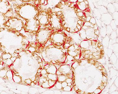 Breast Cancer Cell
