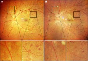Fundus photography images of a left eye in PDR patient complicated with DME demonstrate significant treatment response in the “1 + 1 + PRN” group at week 13.