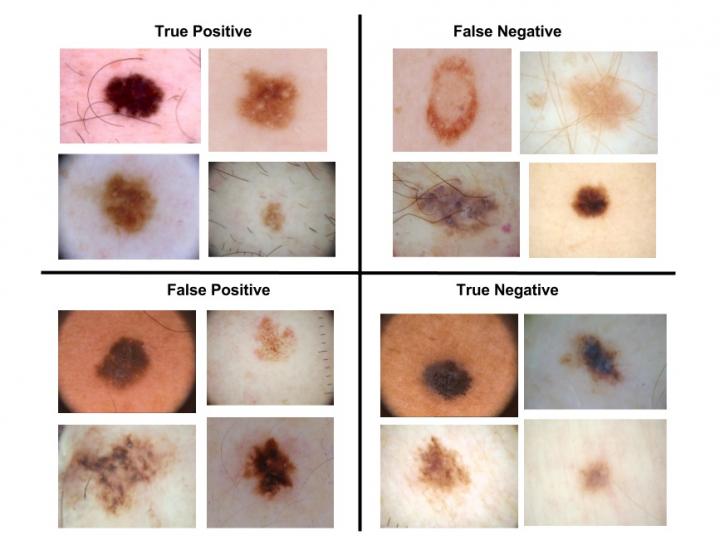 This 'Sweet Spot' Could Improve Melanoma Diagnosis (2 of 2)