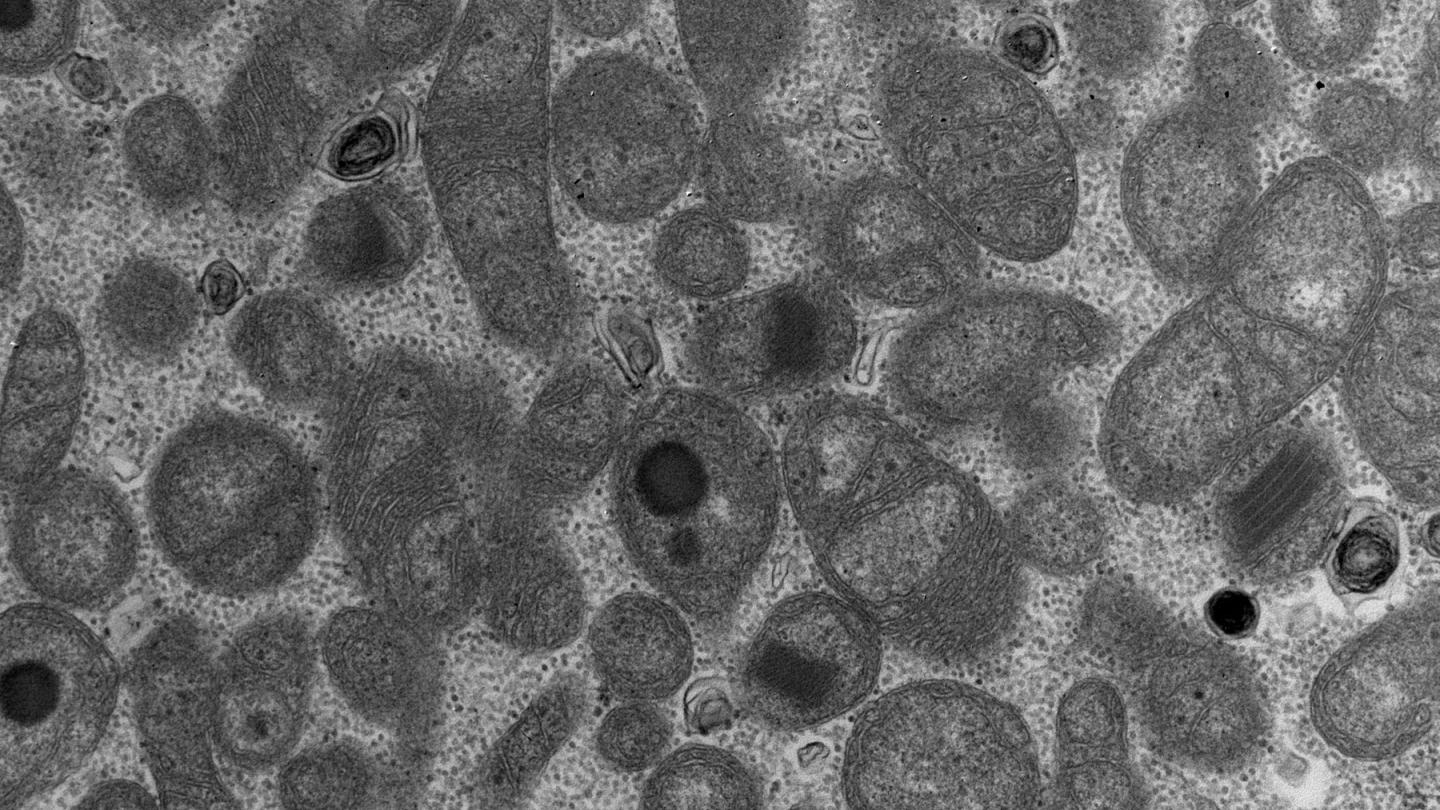 Mitochondrial disease