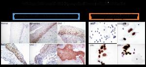 New Technology Developed for Early Detection of Cervical Precancerous Pesions