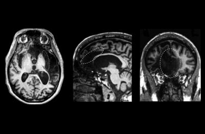 Self-Awareness and the Brain