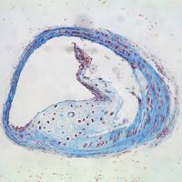 Ruptured Plaque