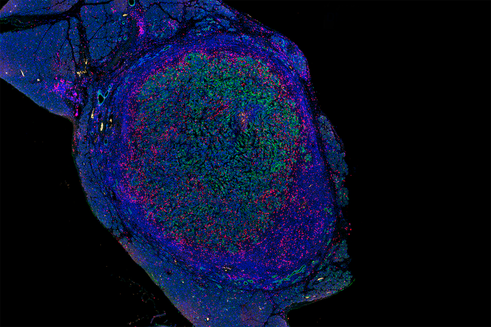 Pancreatic Tumor