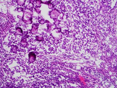 Serous Endometrial Cancer