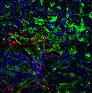 CD74⁺ microglia/macrophages surrounding and infiltrating experimental brain metastasis