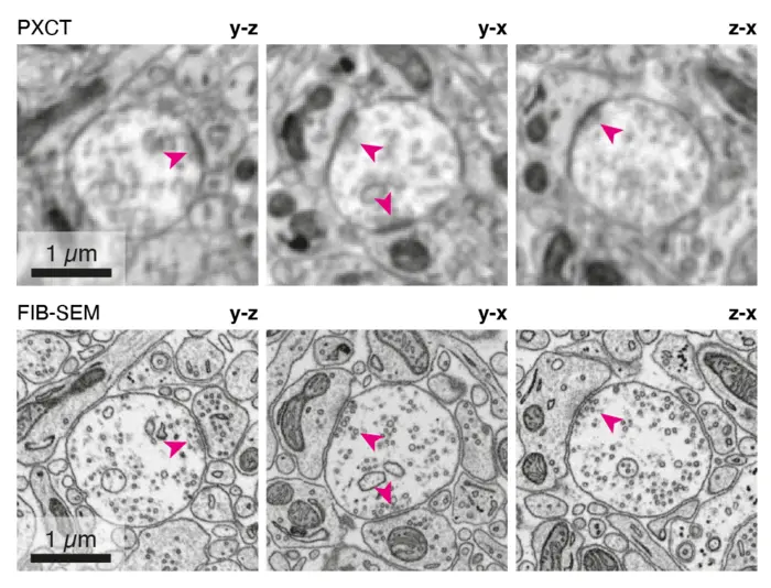 Comparing X-ray ptychography and volume EM imaging