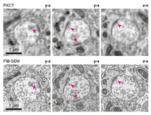 Comparing X-ray ptychography and volume EM imaging