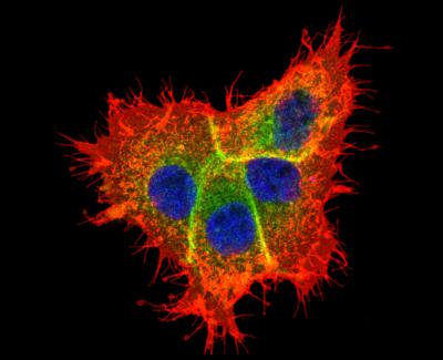 PRL-3 Enhances Motility of Cancer Cells by Activating Another Cancer-Causing Gene, EGFR