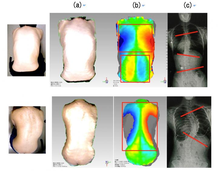 Image Analyses of Idiopathic Scoliosis Sufferers Using 3-D, Back-Surface-Symmetry-Recognition System