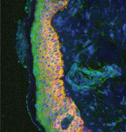 Common Psoriasis