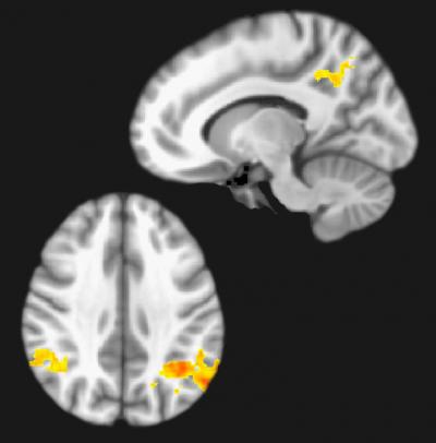 Brain Imaging Pain Medicines