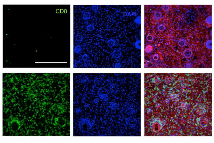 Fighting Cancer with the Power of Immunity