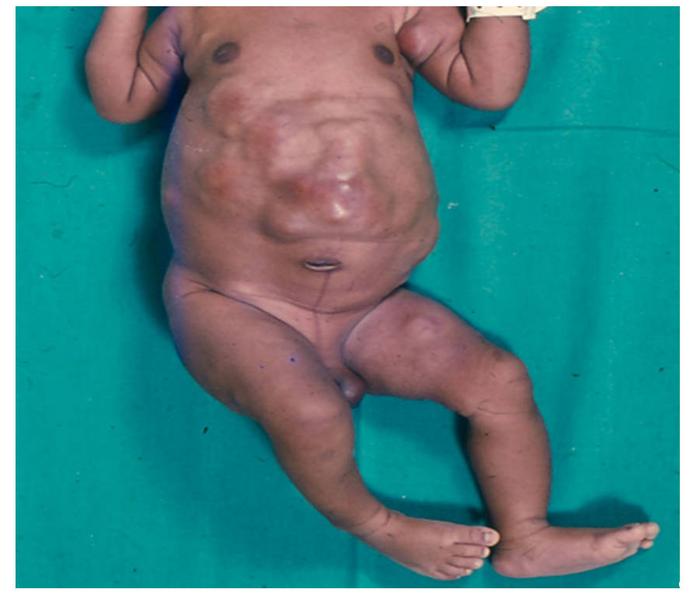 Infant with stage MS (metastatic special) neuroblastoma.