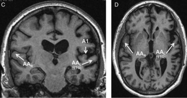 Patient Brain Scan