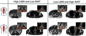 Exemplary cases across four intermuscular adipose tissue–lean muscle mass z-score combinations