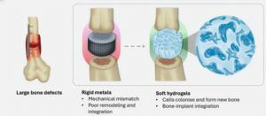 Graphic comparing rigid metals and soft hydrogels in bone fractures.