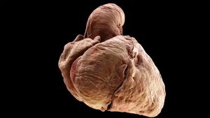 3D Rendering of a heart showing the four key features of Tetralogy of Fallot