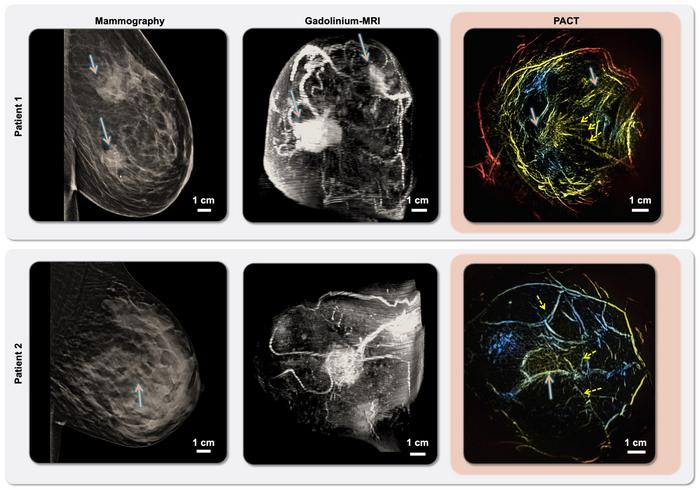 Mammography/MRI/PACT imaging of invasive ductal carcinoma