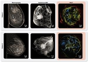 Mammography/MRI/PACT imaging of invasive ductal carcinoma
