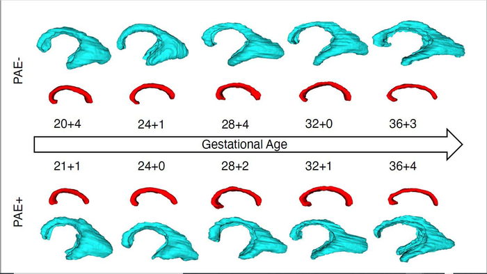 MRI Reveals Altered Brain Structure in Fetuses Exposed to Alcohol