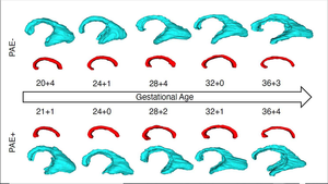 MRI Reveals Altered Brain Structure in Fetuses Exposed to Alcohol