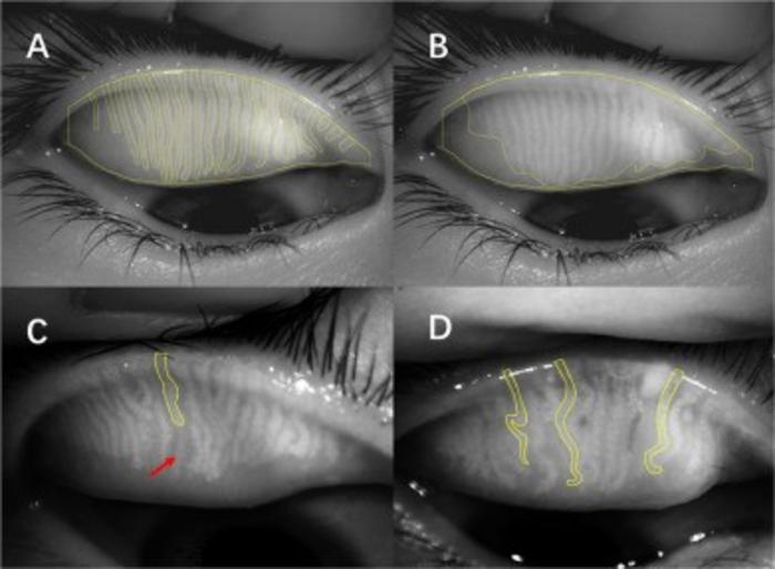 Standardized meibomian gland annotation methods improve AI-ready dry eye imaging analysis and diagnosis