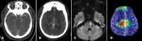 Deep Learning Model Provides Rapid Detection of Stroke-causing Blockages