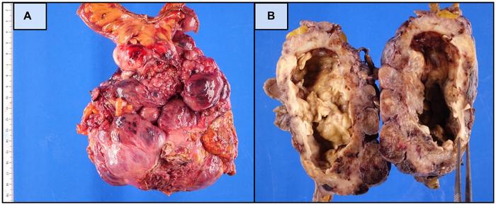 Small bowel GIST harboring concurrent KIT exon 9 duplication and SDHC mutation: A case report