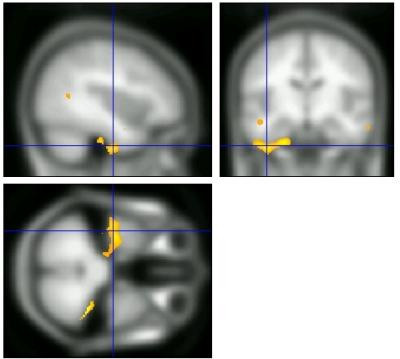 MRI Scan