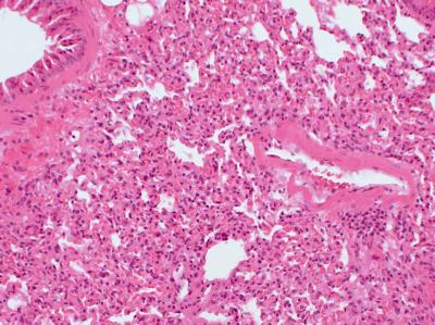 Lung Tissue c-FLIP