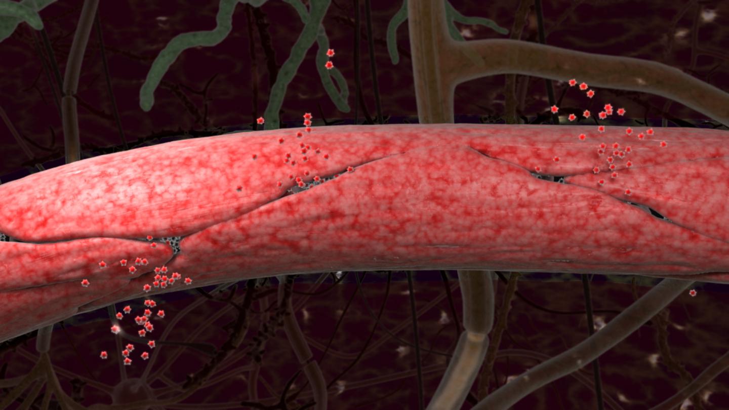 Leaky Capillaries in the Brain May Drive Dementia