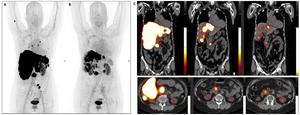 An example of partial response. 58-year-old patient with neuroendocrine neoplasm of the pancreas with hepatic and bone metastases.