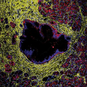 pancreatic precursor lesion