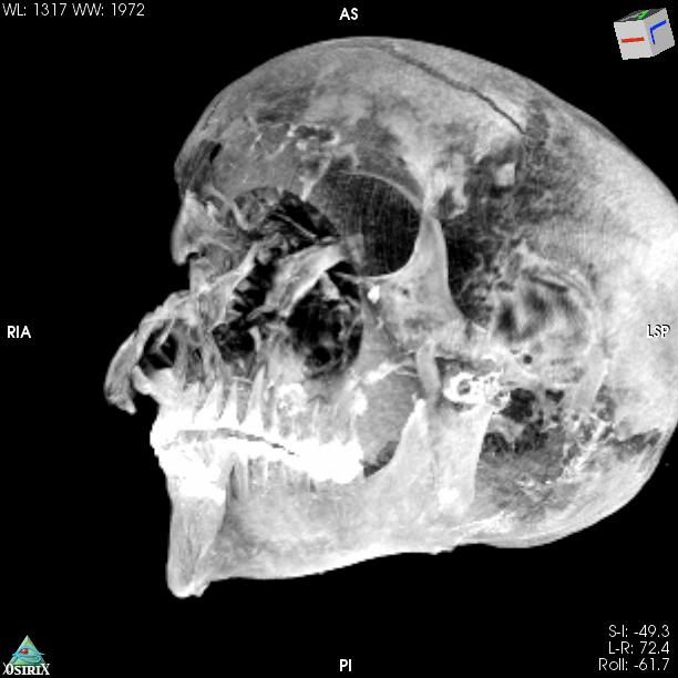 Skull