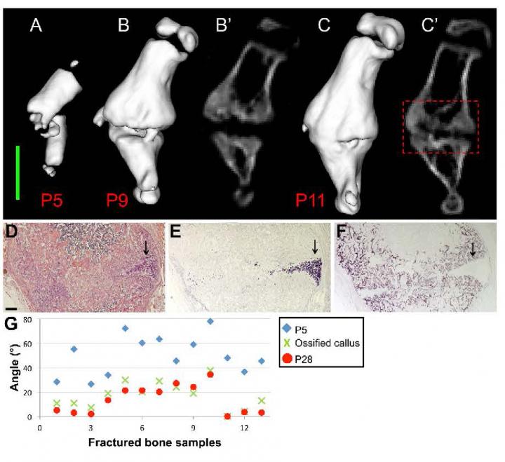 Callus Ossification Progresses after Most of the Realignment Has Occurred