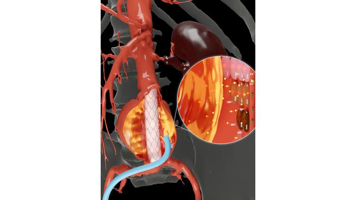 Advanced Shear-Thinning Hydrogel for Aneurysm Repair