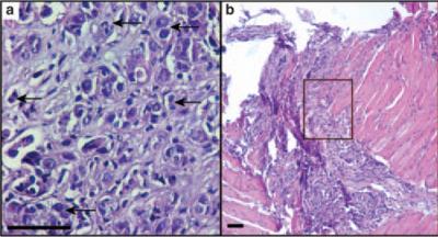 IL25 Breast Cancer Cells