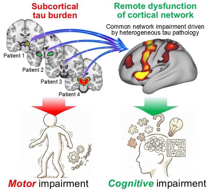How Tau Buildup May Affect Brain Networks in PSP