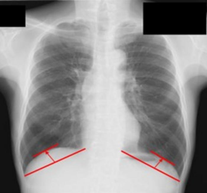 Chest X-Ray Marker for Predicting Lung Cancer Outcomes