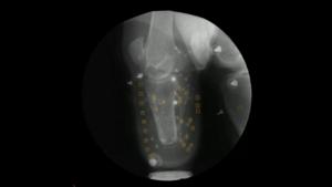 Prosthetic leg X-ray (walking)