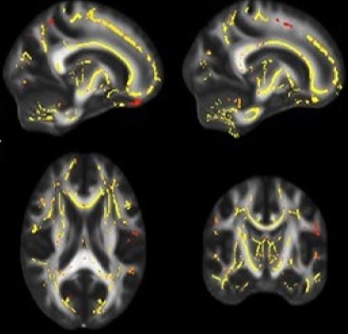 White Matter