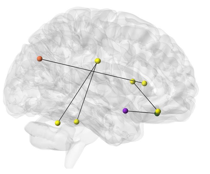 Brain regions tied to frailty
