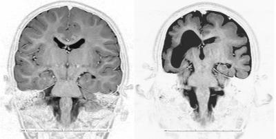 Malformations of Cortical Development