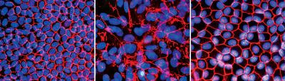 Diseased Retinal Cells are Treated with Gene Therapy