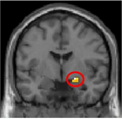 Amygdala Activity
