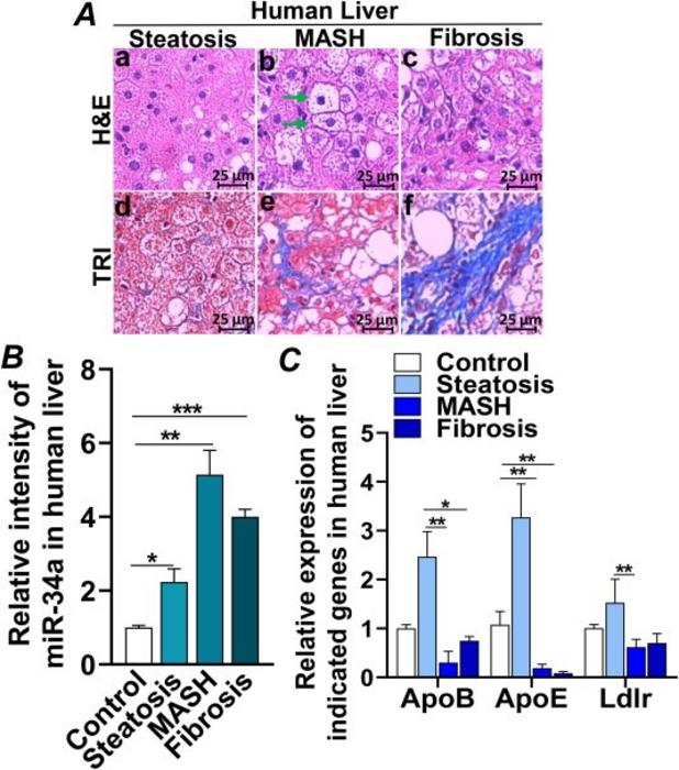 Increased miR-34a in the livers of patients with steatosis, MASH, and liver fibrosis.
